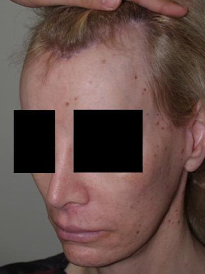 Hair for Gender Reaffirmation Before & After Gallery - Patient 145586 - Image 3