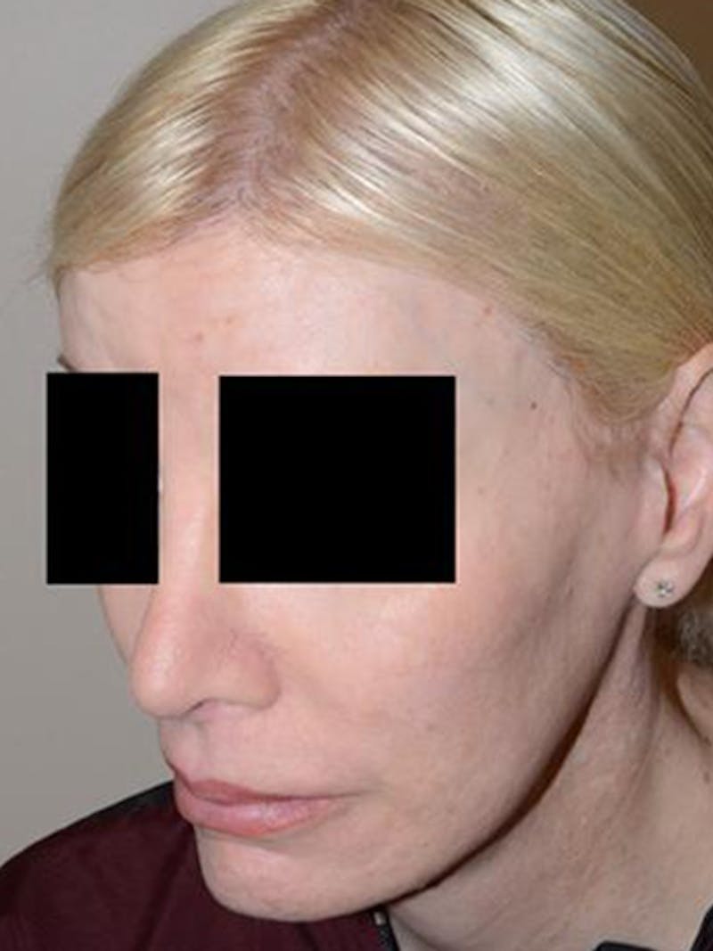Hair for Gender Reaffirmation Before & After Gallery - Patient 145586 - Image 4
