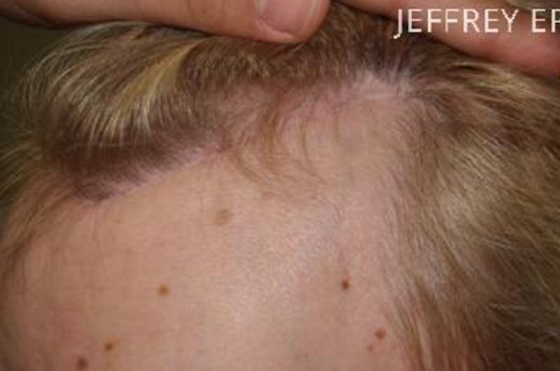 Hair for Gender Reaffirmation Before & After Gallery - Patient 145586 - Image 5