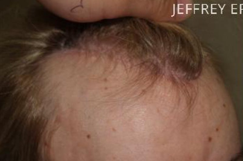 Hair for Gender Reaffirmation Before & After Gallery - Patient 145586 - Image 7