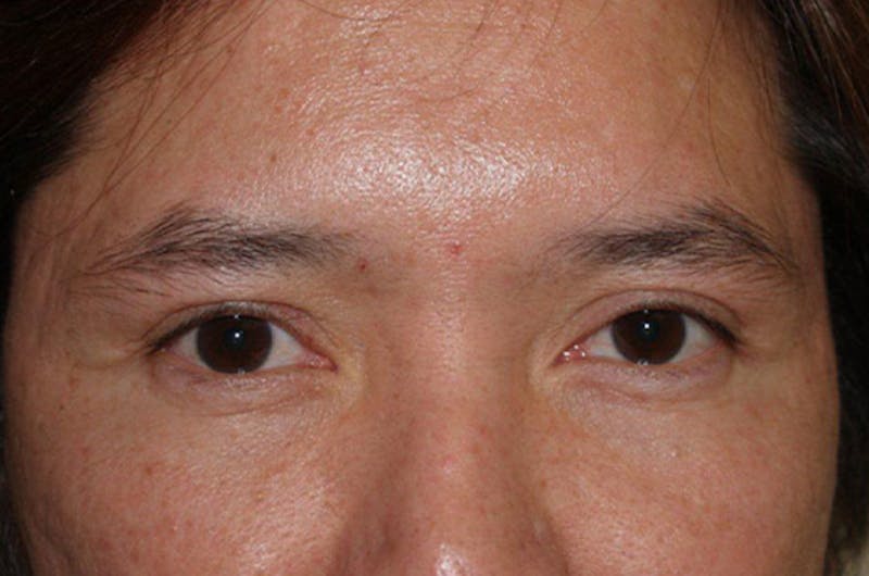Hair for Gender Reaffirmation Before & After Gallery - Patient 346428 - Image 3
