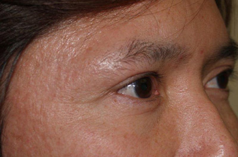 Hair for Gender Reaffirmation Before & After Gallery - Patient 346428 - Image 5