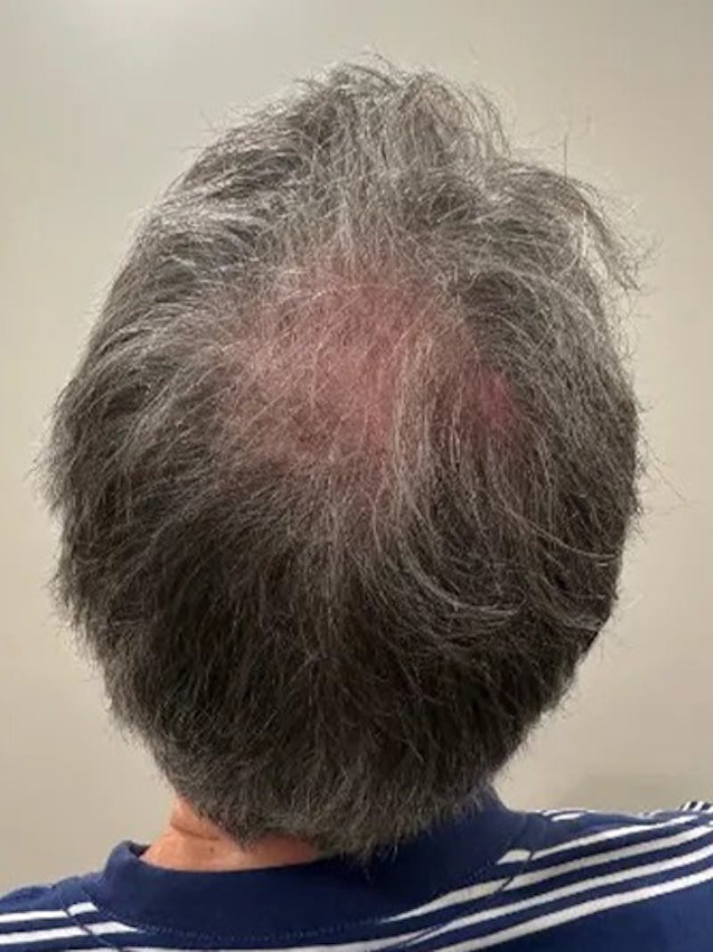 Scalp Micropigmentation Procedures Before & After Gallery - Patient 124759 - Image 1