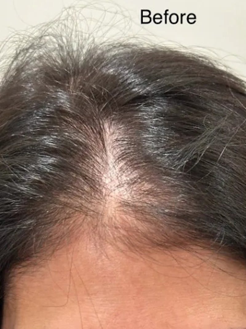 Scalp Micropigmentation Procedures Before & After Gallery - Patient 345746 - Image 3