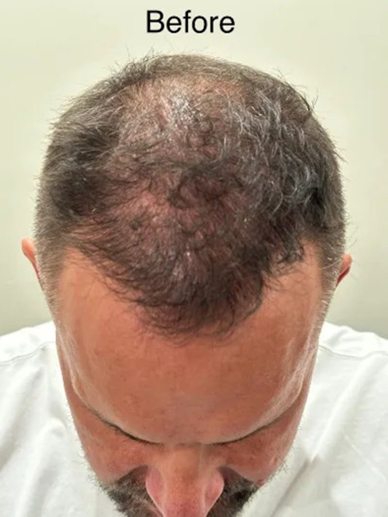Scalp Micropigmentation Procedures Before & After Gallery - Patient 199053 - Image 3