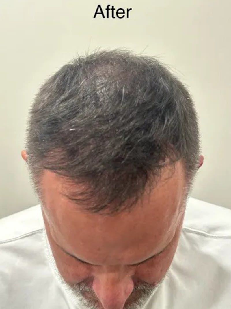 Scalp Micropigmentation Procedures Before & After Gallery - Patient 199053 - Image 4