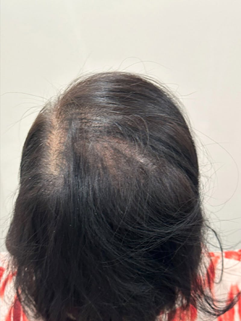 Scalp Micropigmentation Procedures Before & After Gallery - Patient 766635 - Image 1