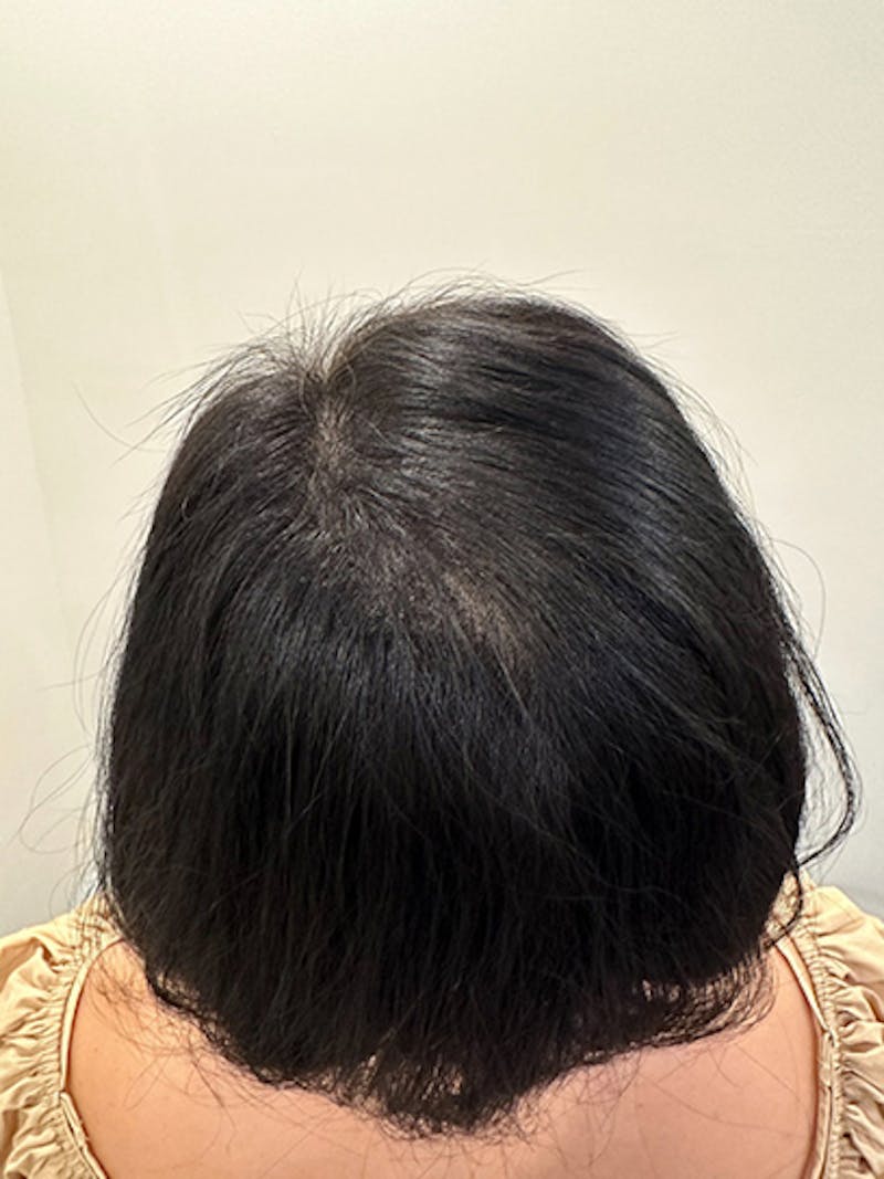 Scalp Micropigmentation Procedures Before & After Gallery - Patient 766635 - Image 2