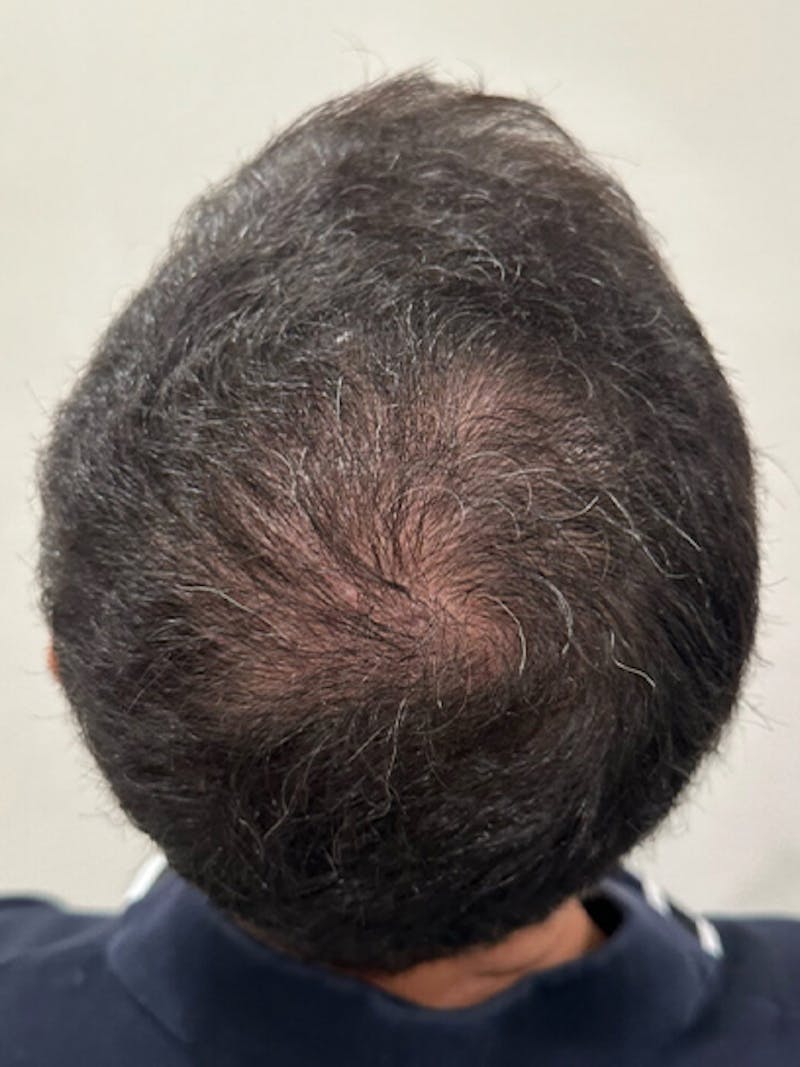 Scalp Micropigmentation Procedures Before & After Gallery - Patient 486749 - Image 1