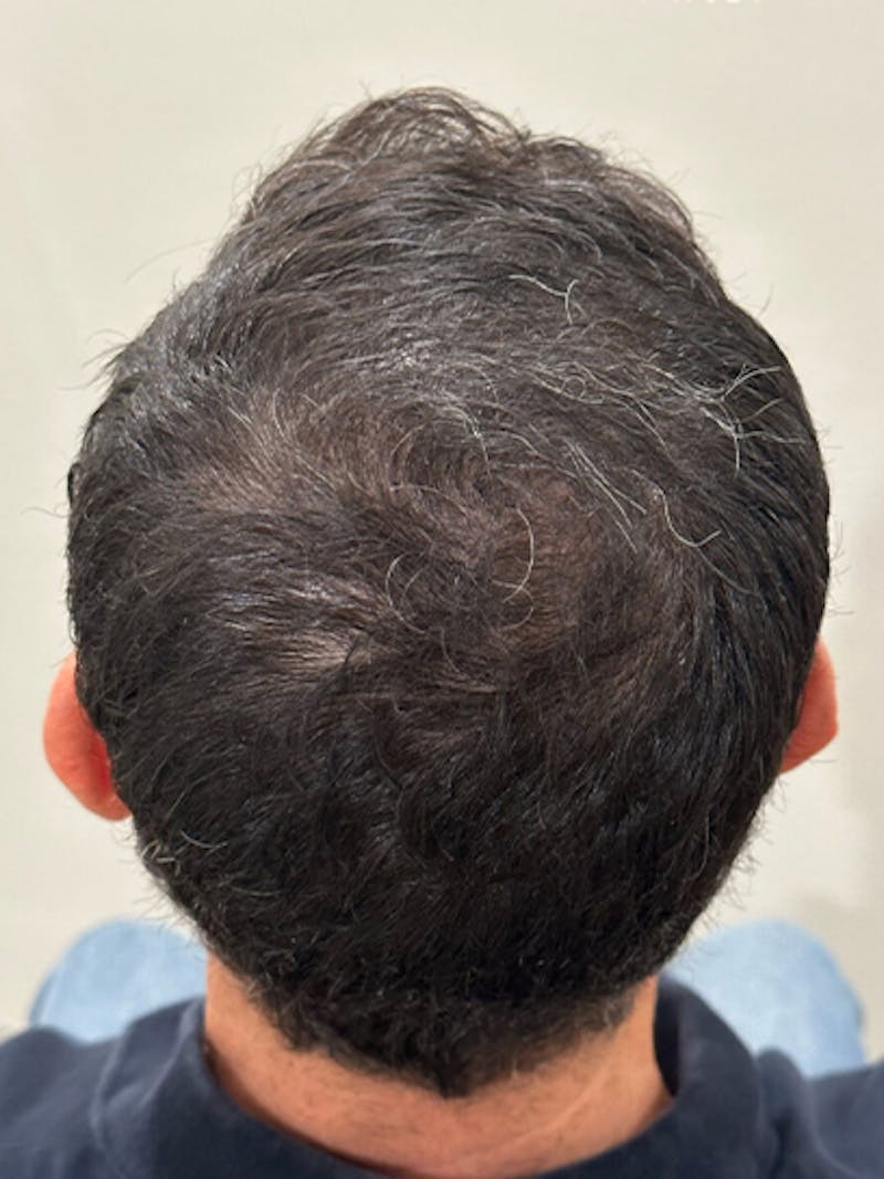 Scalp Micropigmentation Procedures Before & After Gallery - Patient 486749 - Image 2