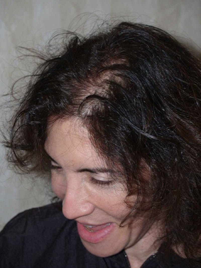 Hair Procedures for Women Before & After Gallery - Patient 403118 - Image 3