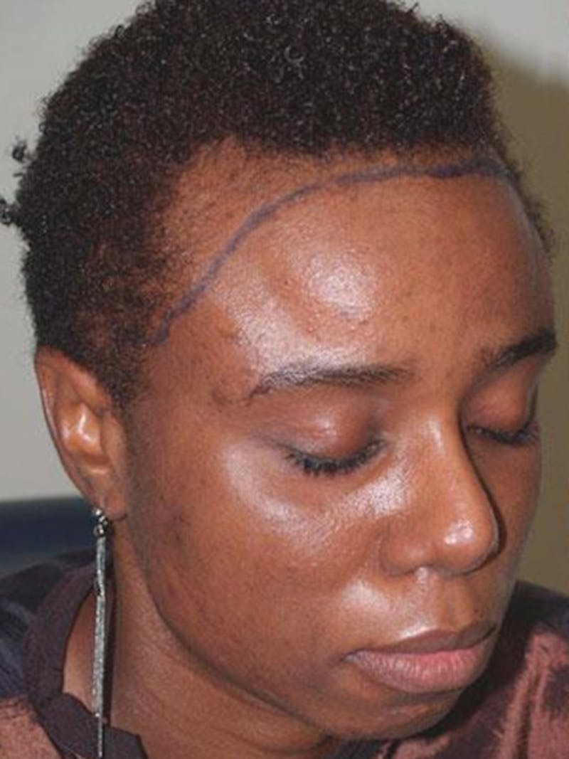 Hair Procedures for Women Before & After Gallery - Patient 369952 - Image 5