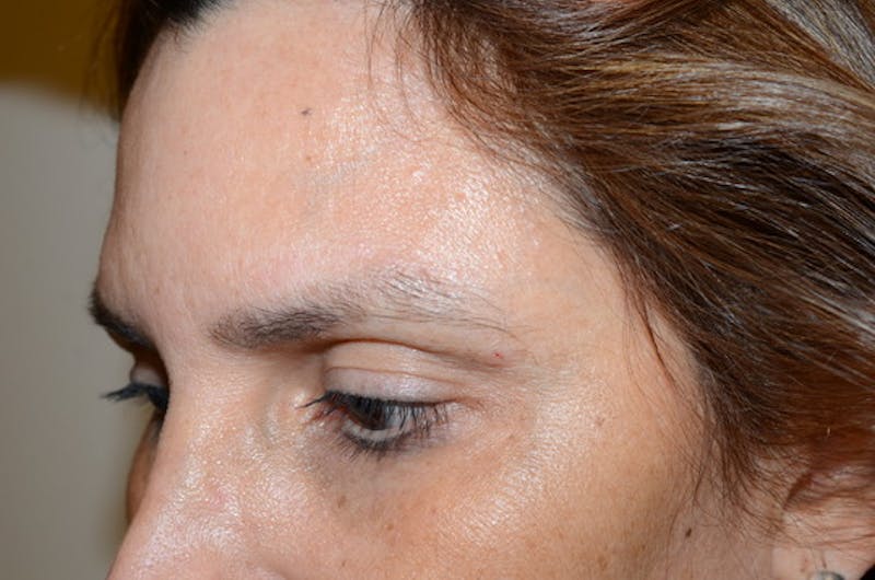 Eyebrow Transplantation Before & After Gallery - Patient 334968 - Image 3