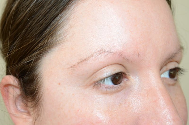 Eyebrow Transplantation Before & After Gallery - Patient 305873 - Image 7