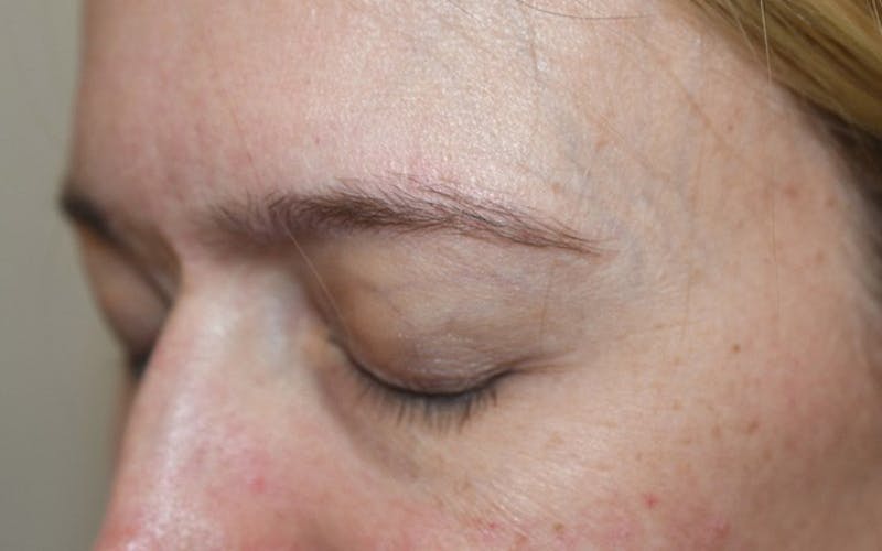 Eyebrow Transplantation Before & After Gallery - Patient 155767 - Image 3