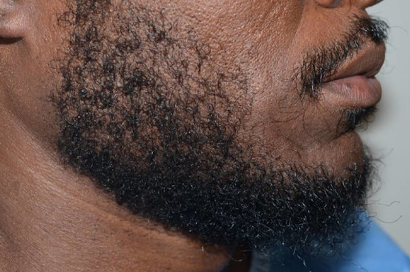 Facial Hair Transplant Before & After Gallery - Patient 145683 - Image 3