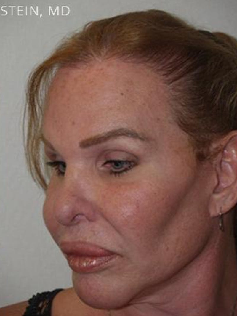 Hairline Lowering Surgery Before & After Gallery - Patient 417733 - Image 4