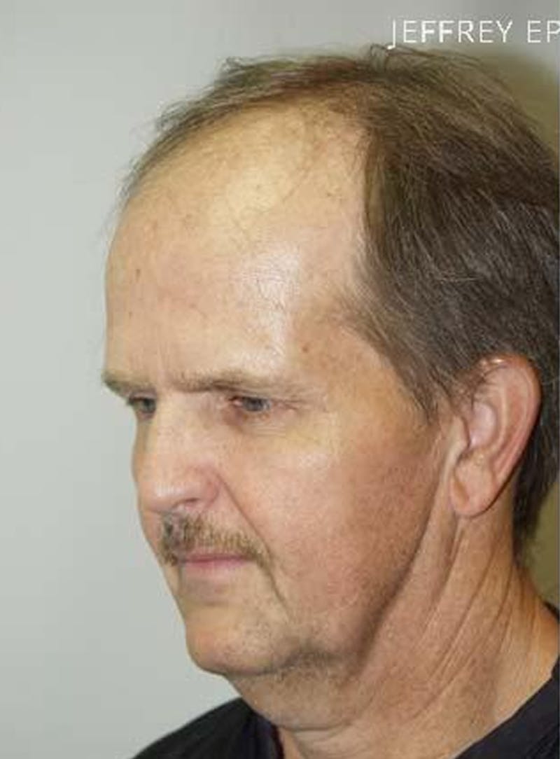 Body Hair Transplants Before & After Gallery - Patient 289518 - Image 3