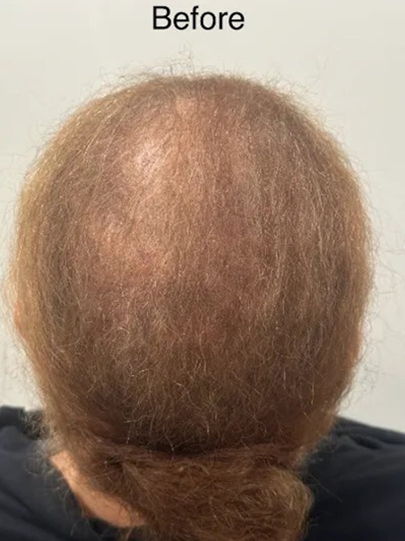 Scalp Micropigmentation Procedures Before & After Gallery - Patient 246005 - Image 3