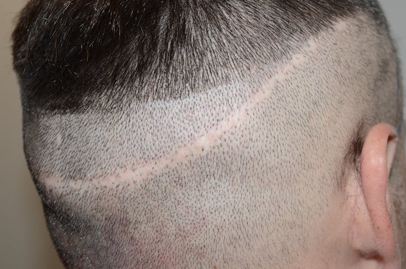 Scalp Micropigmentation Procedures Before & After Gallery - Patient 109773 - Image 3