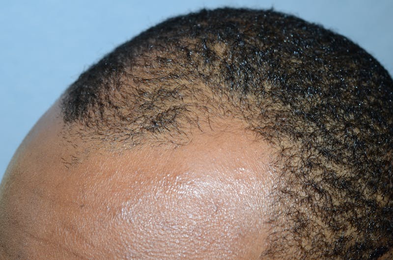 Scalp Micropigmentation Procedures Before & After Gallery - Patient 121271 - Image 3