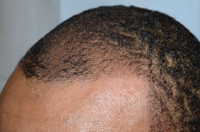 Scalp Micropigmentation Procedures Before & After Gallery - Patient 121271 - Image 4