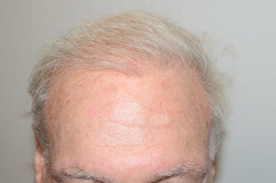 Body Hair Transplants Before & After Gallery - Patient 109577 - Image 2