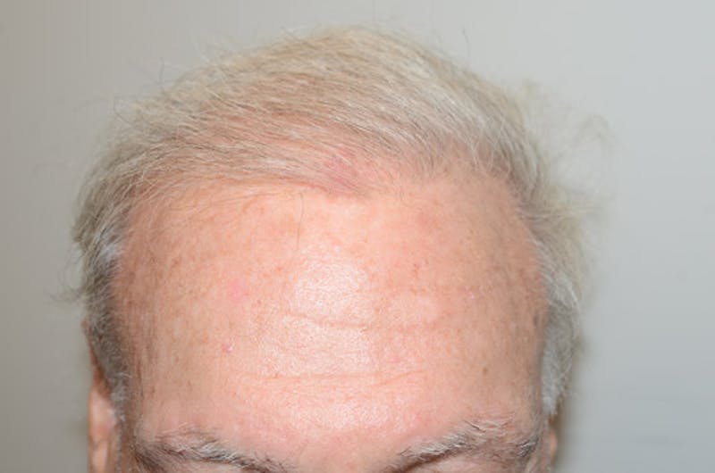 Body Hair Transplants Before & After Gallery - Patient 158343 - Image 2