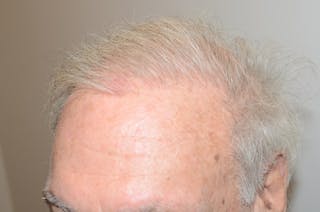 Body Hair Transplants Before & After Gallery - Patient 130167 - Image 4