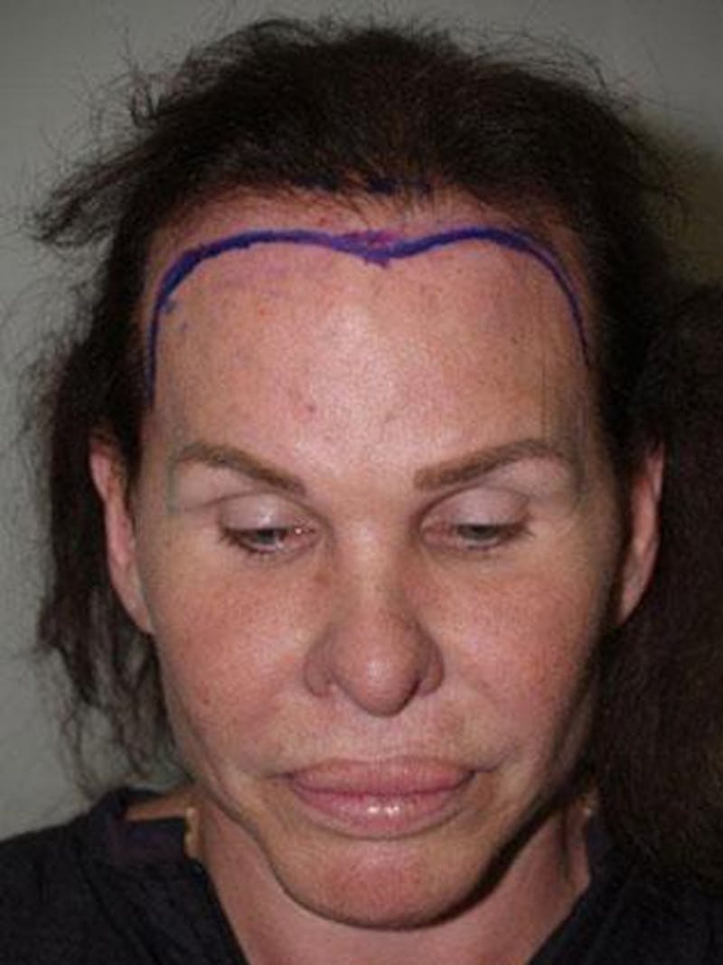 Hair For Gender Reaffirmation Before & After Gallery - Patient 366357 - Image 1