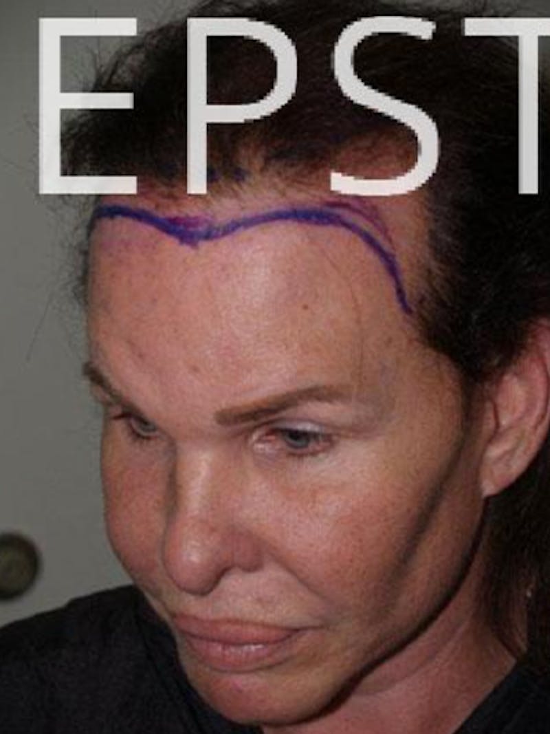 Hair For Gender Reaffirmation Before & After Gallery - Patient 366357 - Image 4
