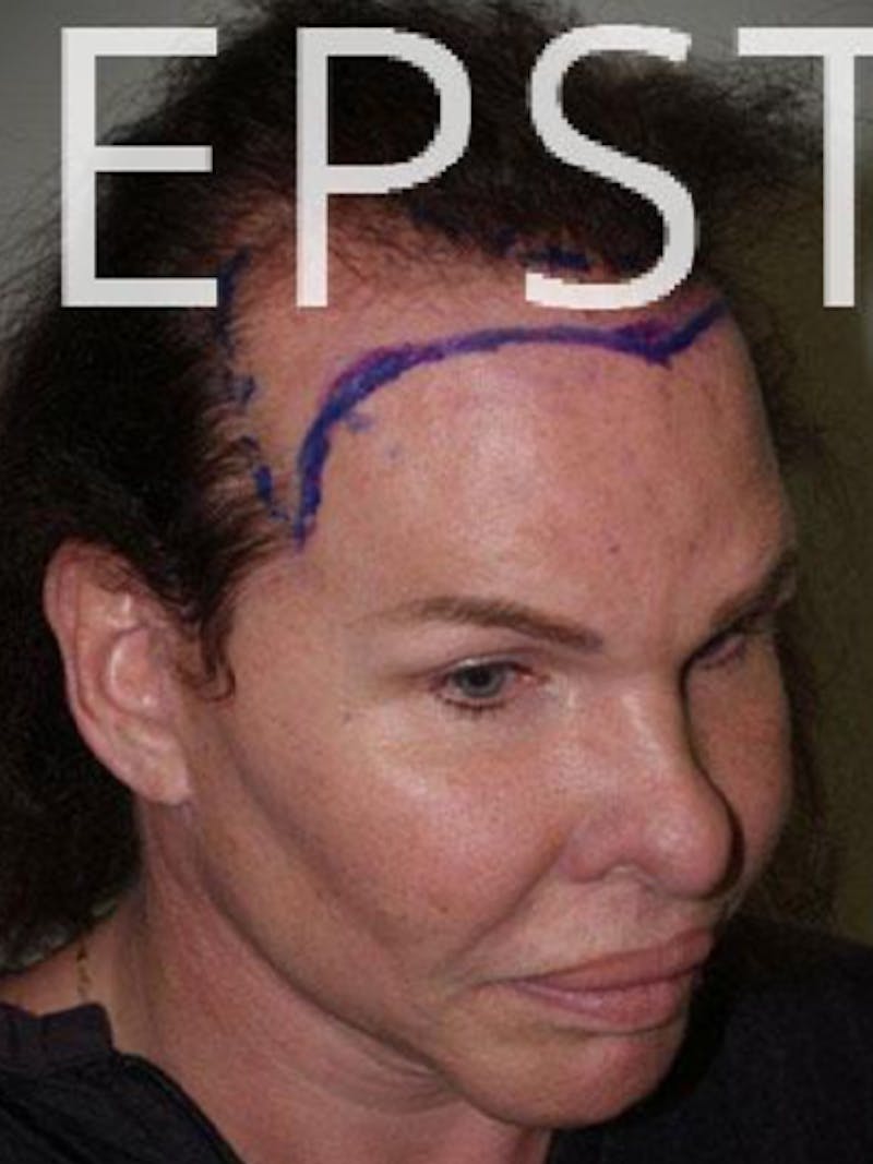 Hair For Gender Reaffirmation Before & After Gallery - Patient 366357 - Image 7