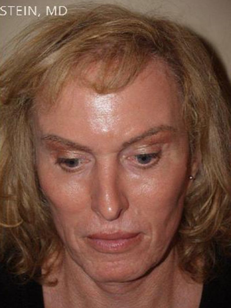 Hair For Gender Reaffirmation Before & After Gallery - Patient 488413 - Image 4