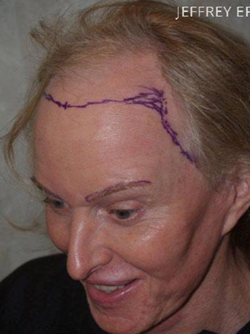 Hair For Gender Reaffirmation Before & After Gallery - Patient 488413 - Image 6