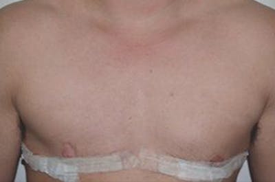 Hair For Gender Reaffirmation Before & After Gallery - Patient 292203 - Image 1