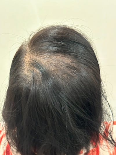 SMP Procedures Before & After Gallery - Patient 242804 - Image 1