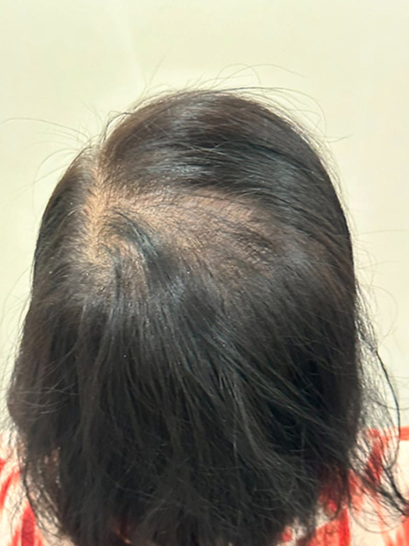 Scalp Micropigmentation Procedures Before & After Gallery - Patient 390045 - Image 1