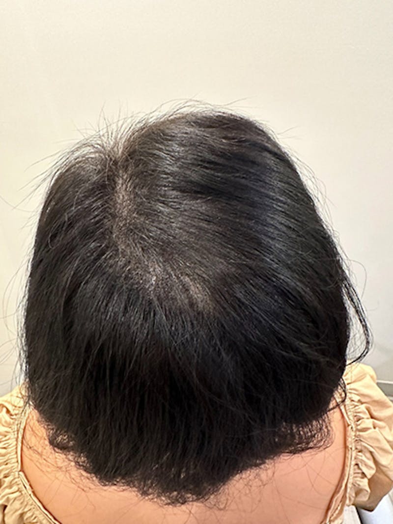 Scalp Micropigmentation Procedures Before & After Gallery - Patient 390045 - Image 3