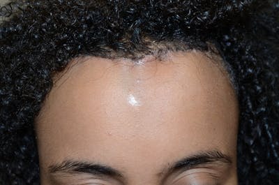 Hairline Lowering Surgery Before & After Gallery - Patient 150259 - Image 2