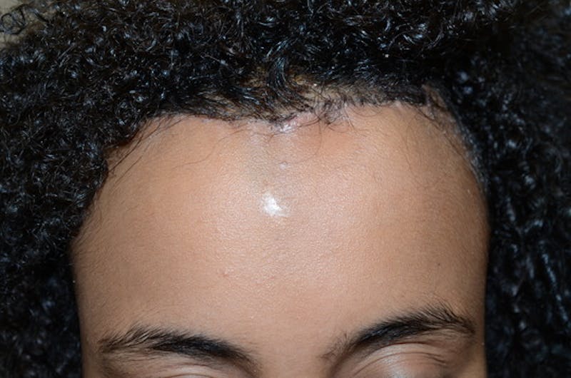 Hairline Lowering Surgery Before & After Gallery - Patient 946658 - Image 2