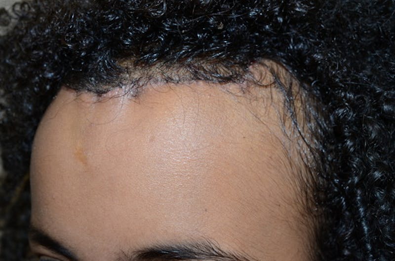 Hairline Lowering Surgery Before & After Gallery - Patient 946658 - Image 5