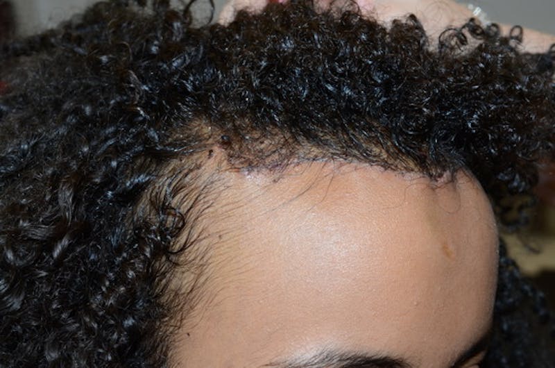 Hairline Lowering Surgery Before & After Gallery - Patient 946658 - Image 8