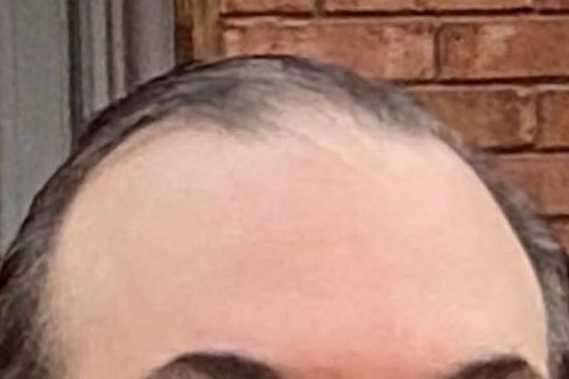 Hair Restoration for Men Before & After Gallery - Patient 651896 - Image 1