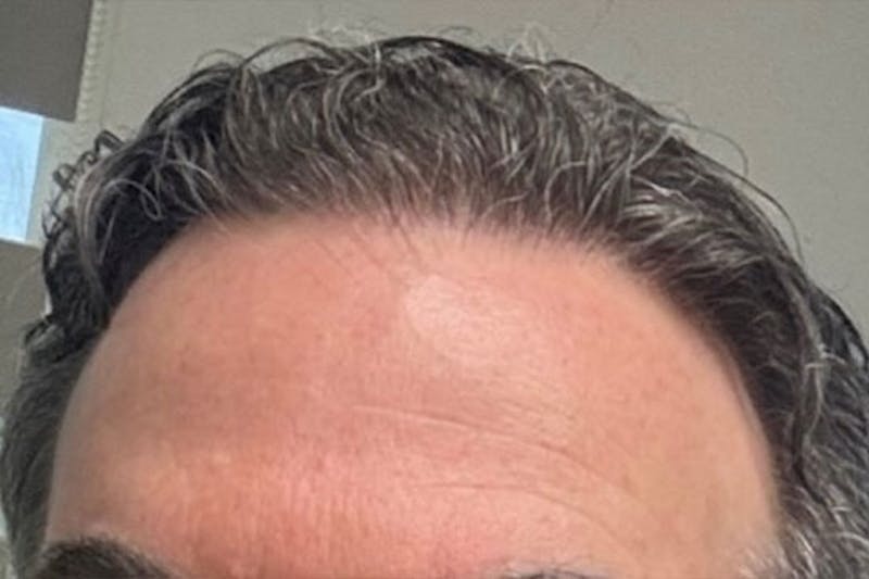Hair Restoration for Men Before & After Gallery - Patient 651896 - Image 2