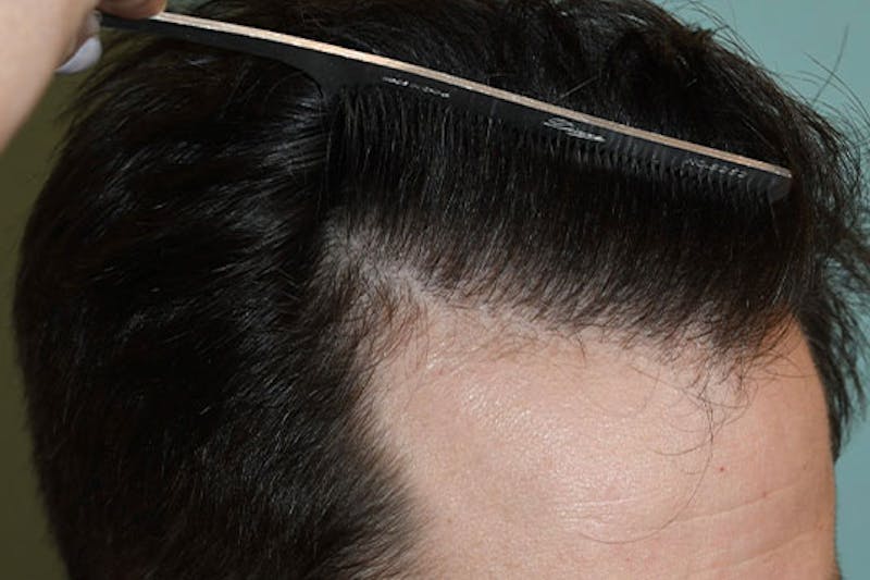 Hair Restoration for Men Before & After Gallery - Patient 386214 - Image 4