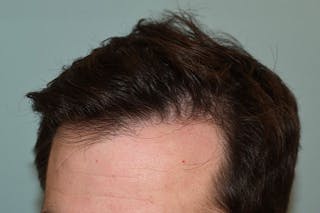 Hair Restoration for Men Before & After Gallery - Patient 386214 - Image 6