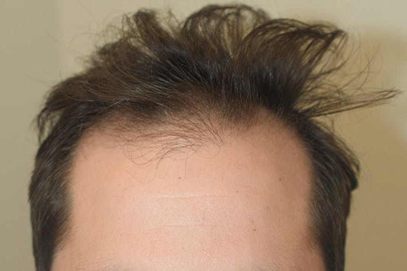 Hair Restoration for Men Before & After Gallery - Patient 386214 - Image 1