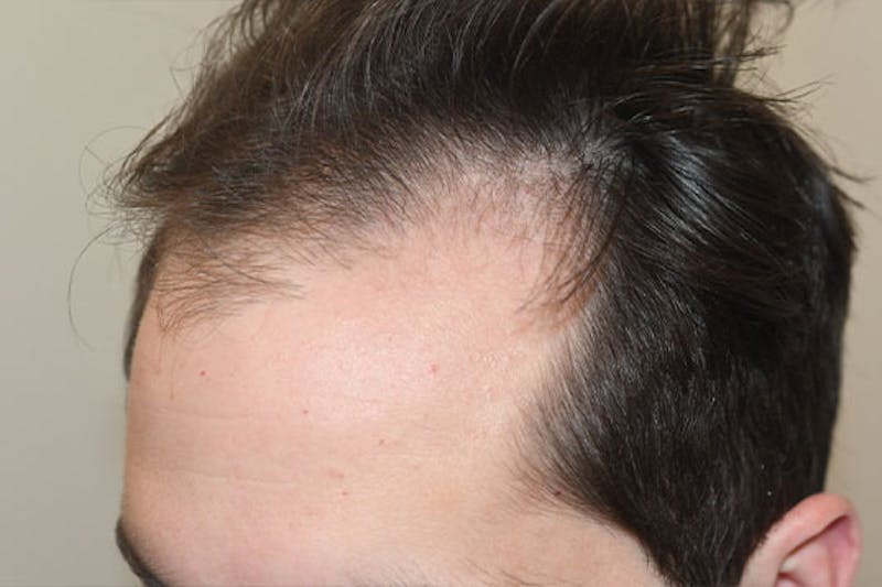 Hair Restoration for Men Before & After Gallery - Patient 386214 - Image 5