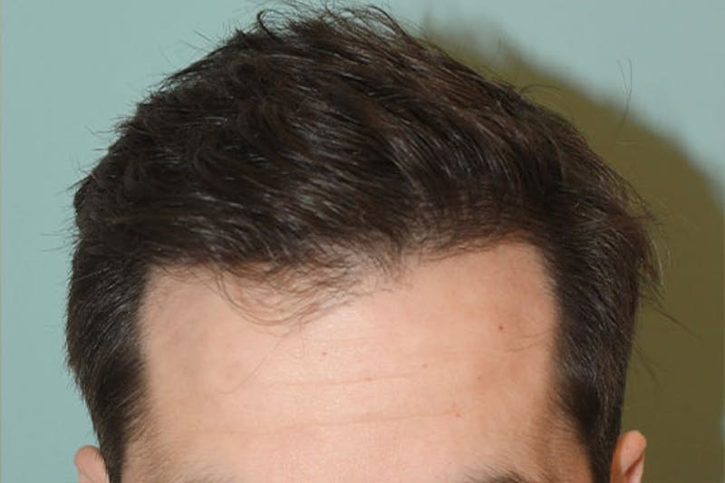 Hair Restoration for Men Before & After Gallery - Patient 386214 - Image 2