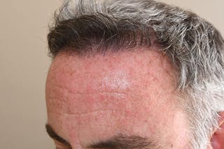 Hair Restoration for Men Before & After Gallery - Patient 304038 - Image 2